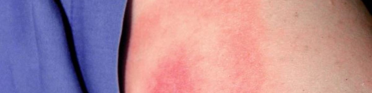 Typical bulls-eye rash from Lyme disease