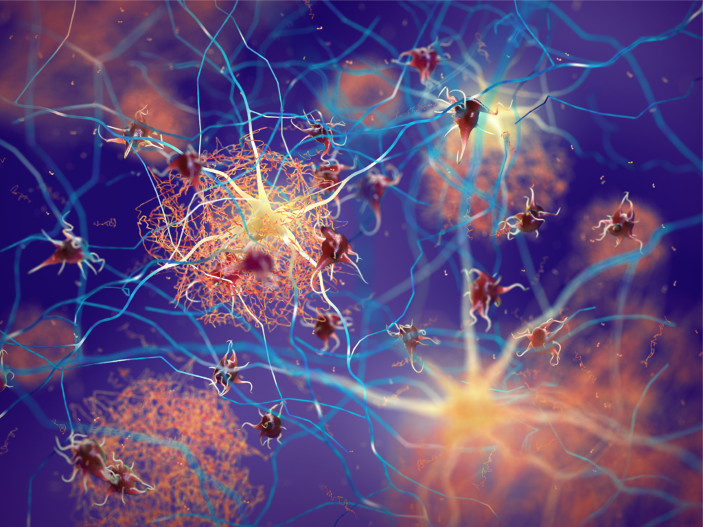 Amyloid plaques forming