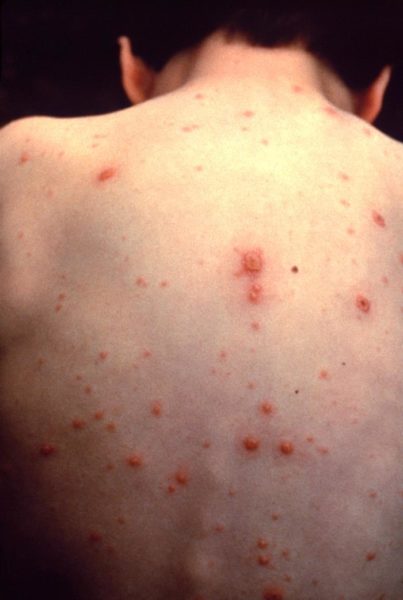 In a primary chicken pox infection, an itchy rash develops followed by formation of pimple-like papules that become small, fluid-filled blisters. The blisters break, form a crust and then heal. Image credit: NIAID