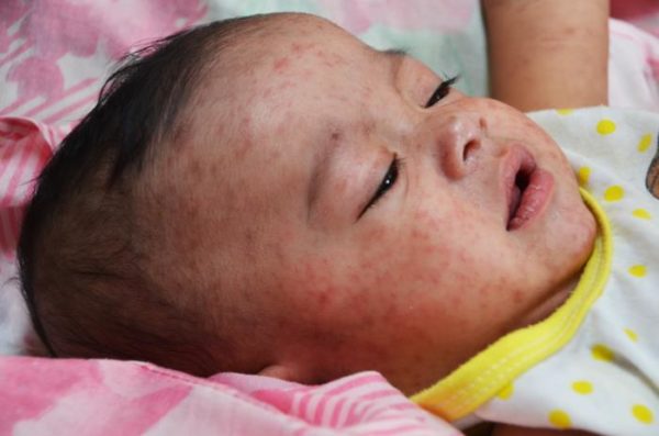 A child with a typical measles rash. Image credit: Jim Goodson, CDC