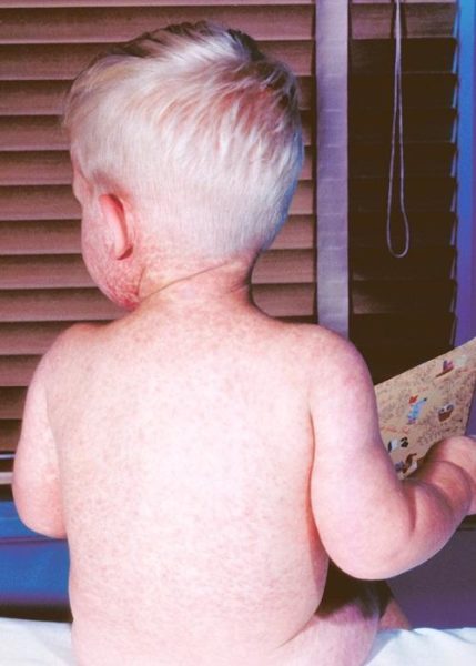 A child with measles showing the typical rash. Image credit: CDC