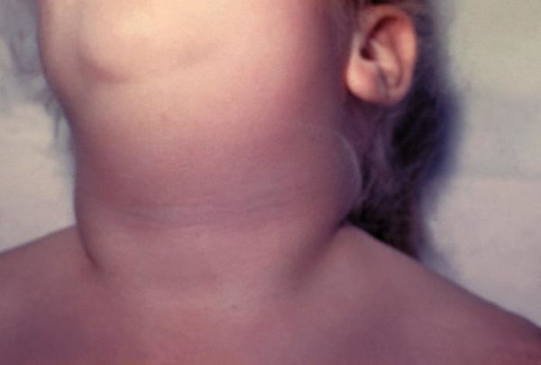 A child with mumps showing the typical swelling of the salivary glands below both ears called parotitis. Image credit: Heinz Eichenwald, CDC