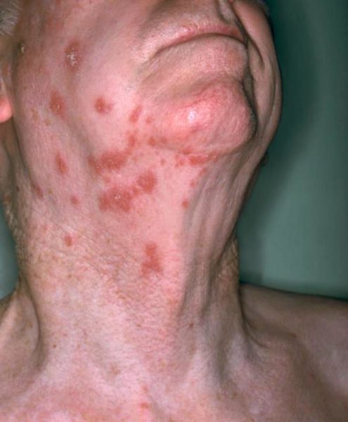 Shingles is a painful rash that develops on one side of the face or body. The rash forms blisters that typically scab over in 7 to 10 days and clears up within 2 to 4 weeks. Image credit: NIAID