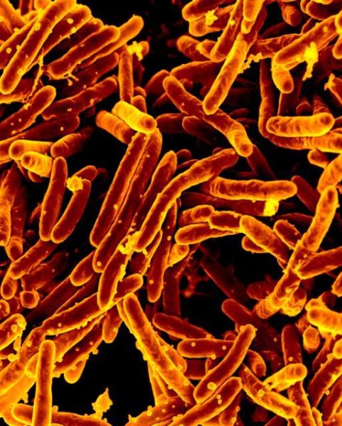 TB is among the world's most common infectious diseases