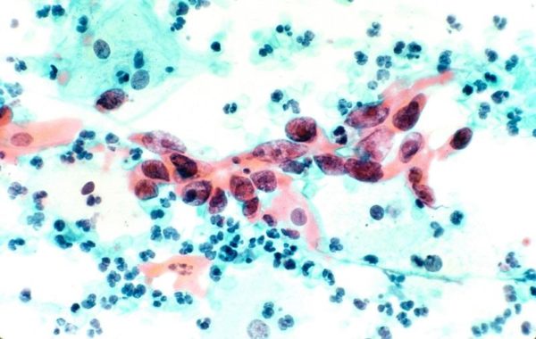 A Pap test (cytological specimen) showing cervical cancer specifically squamous cell carcinoma in the cervix. Image credit: National Cancer Institute