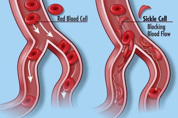 Normal blood cells (left) and the blood cells in Sickle cell disease, which do not flow through the circulatory system smoothly. Image credit: Darryl Leja, NHGRI